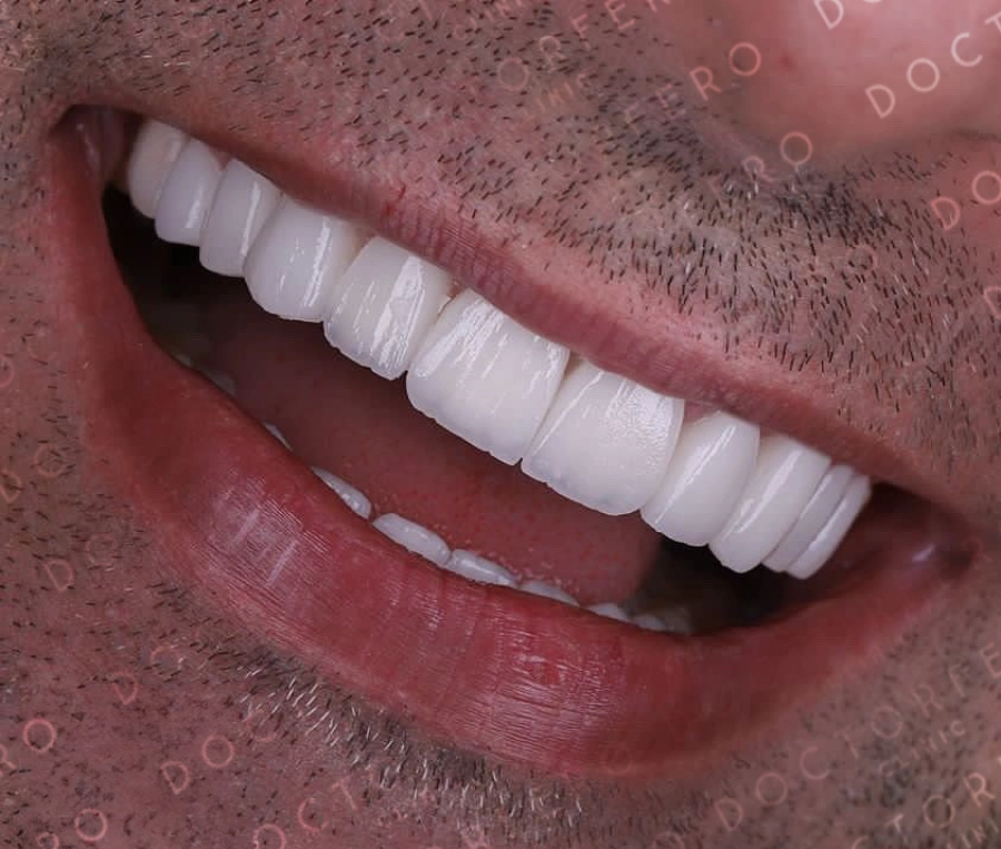 All-on-4 Dental Implants in Turkey