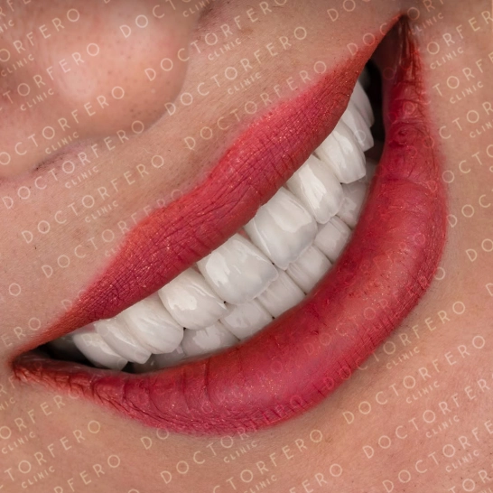 Hollywood Smile in Turkey Before After