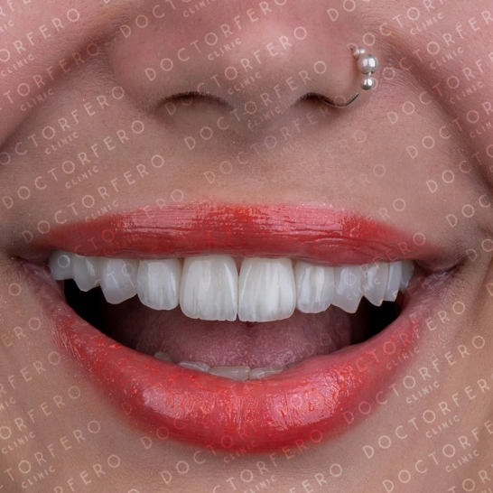Hollywood Smile in Turkey Before After