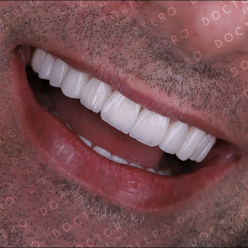 Dental Implants in Turkey