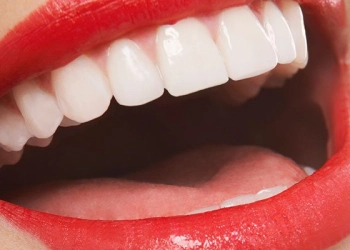How Much Does Hollywood Smile Treatment Cost?
