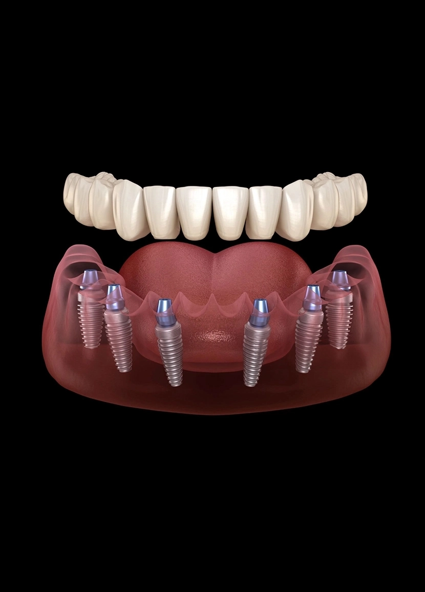 All-on-6 Dental Implants in Turkey