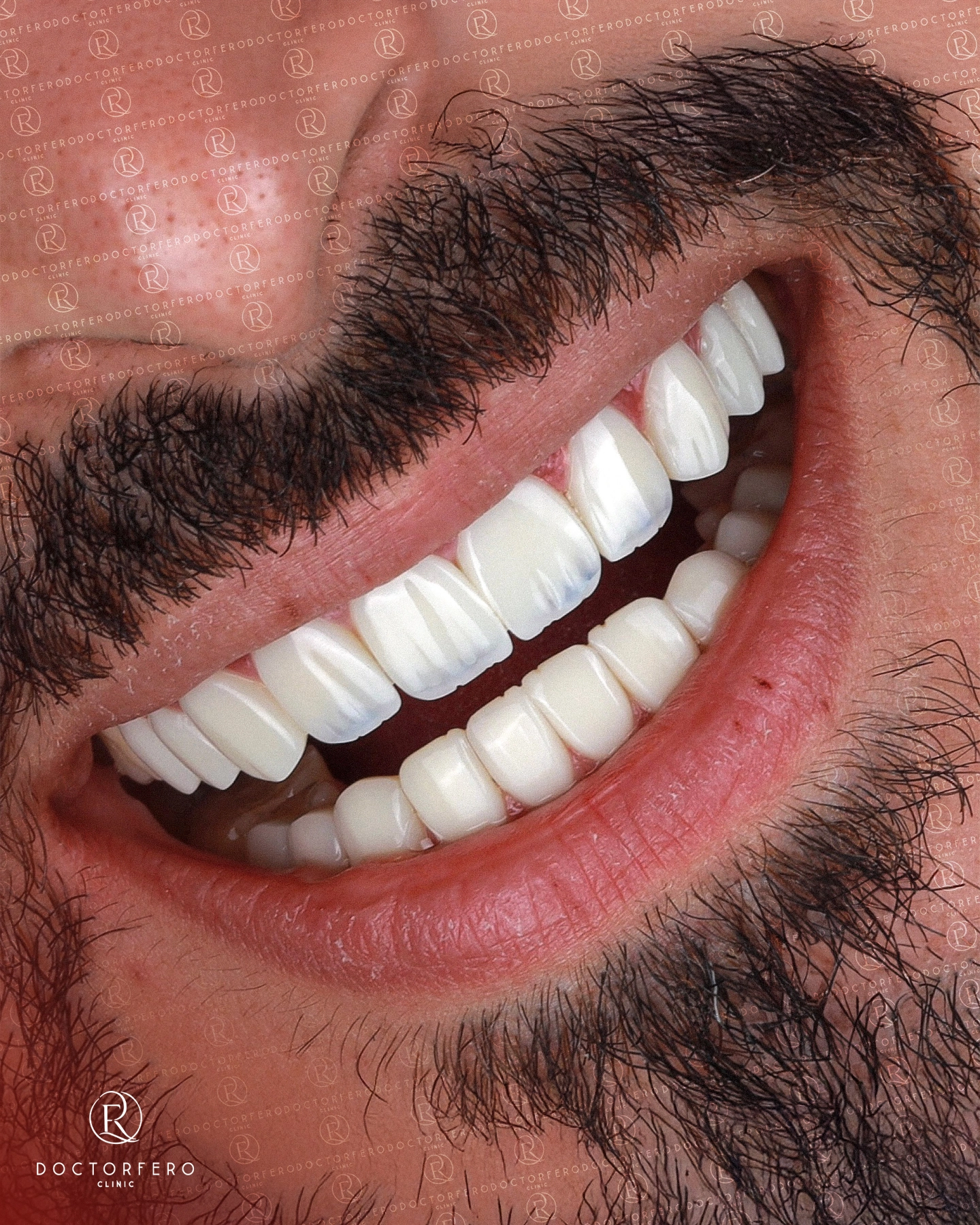 Dental Crowns in Turkey