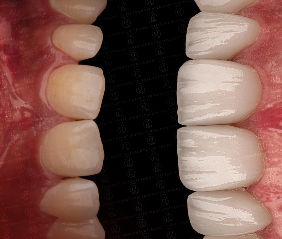 E-Max Crowns in Turkey