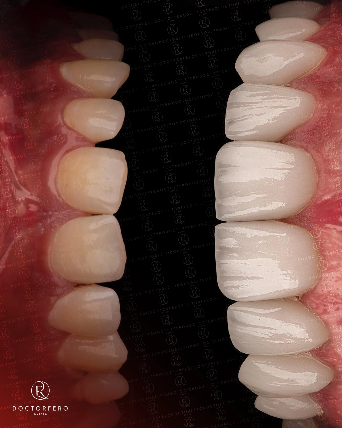 E-Max Crowns in Turkey