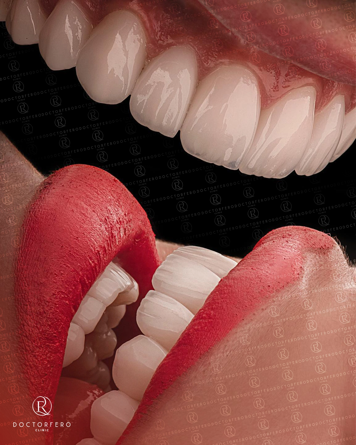 Hollywood Smile in Turkey