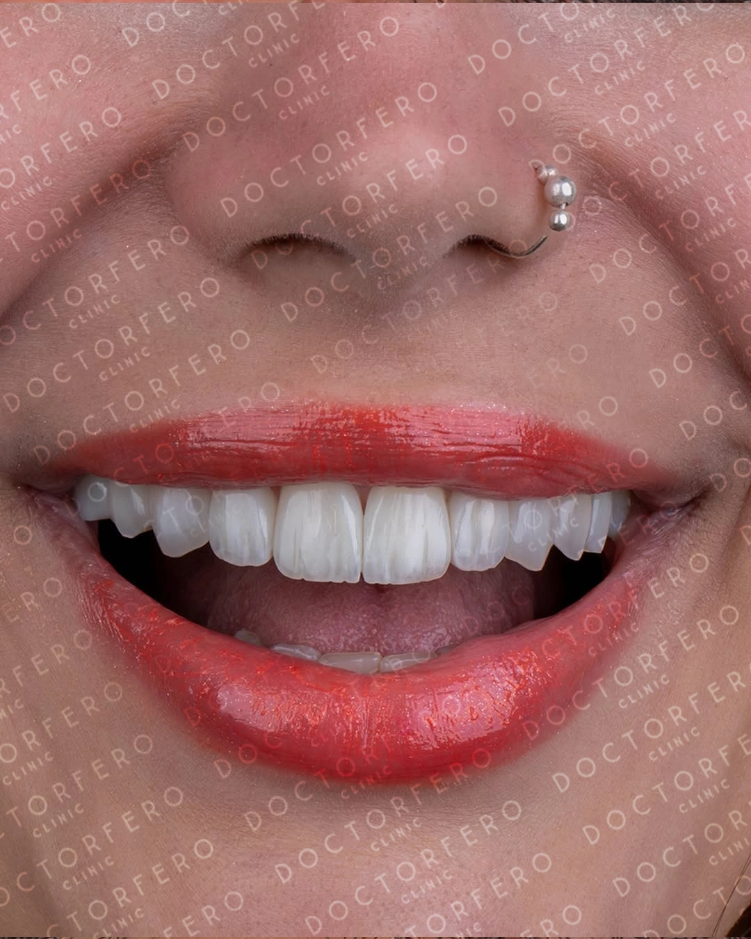 Zirconia Crowns in Turkey